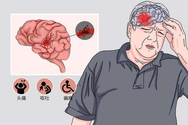 脑出血高发季，这些危险行为千万不要做！